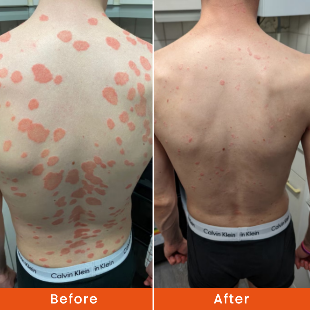 inflamed patches