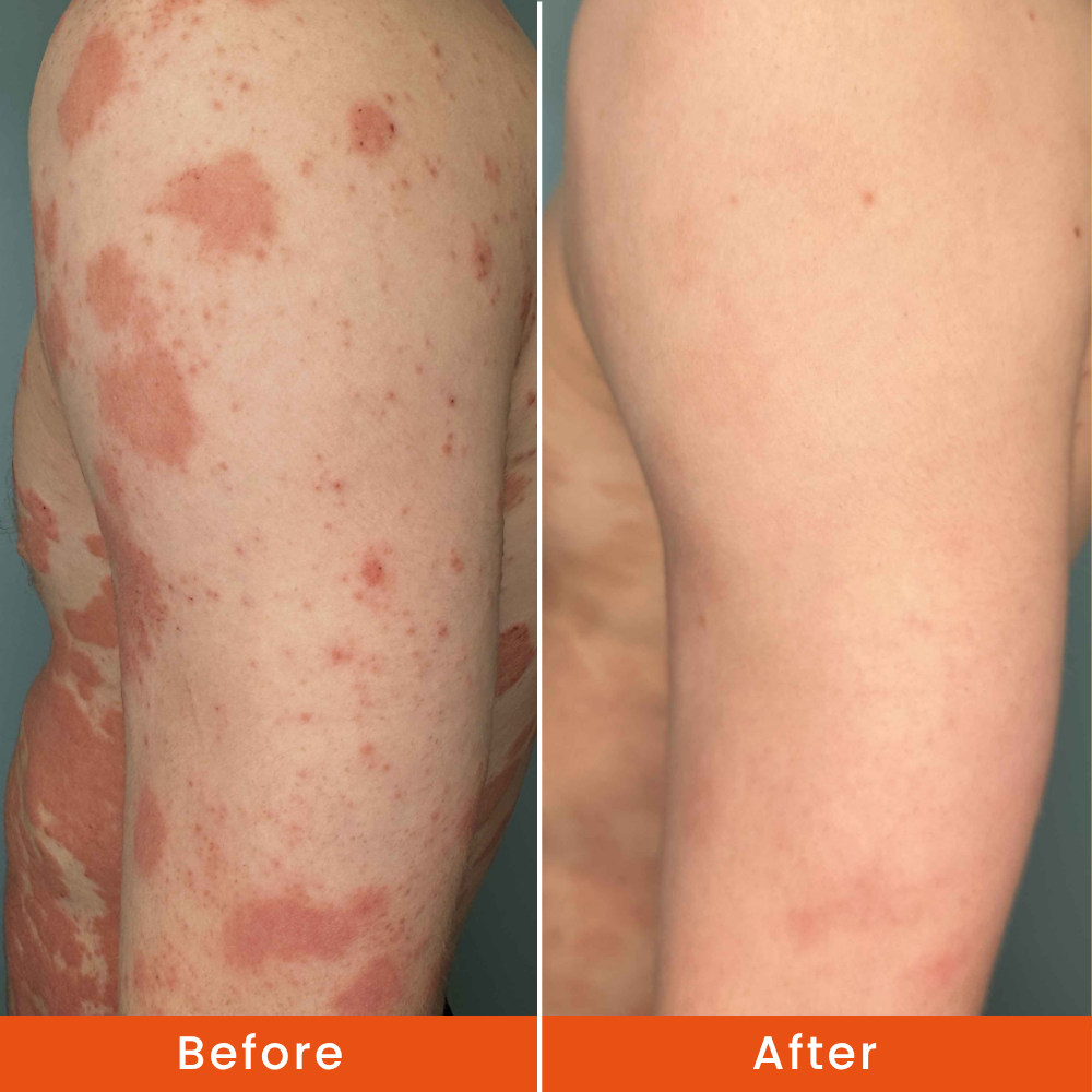 son’s eczema